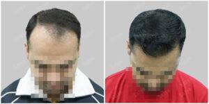 hair transplant before and after