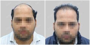 hair transplant before and after