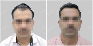 hair transplant before and after