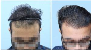 hair transplant before and after