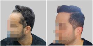hair transplant before and after