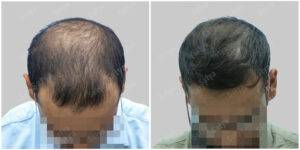 hair transplant results at satya hair solutions