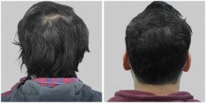 hair transplant