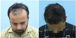 hair transplant before and after