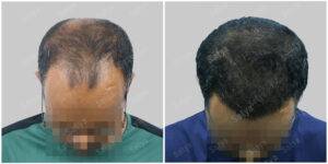 hair transplant results at satya hair solutions