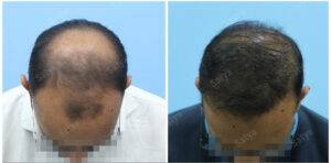 hair transplant results before and after