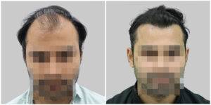 hair transplant before and after
