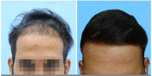 hair transplant results before and after