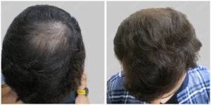 hair transplant before and after