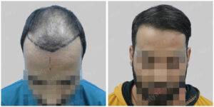hair transplant before after results