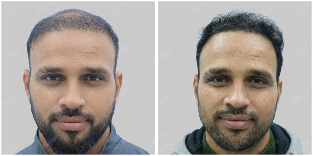 hair transplant before and after