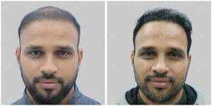 hair transplant before and after