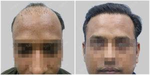 hair transplant before and after