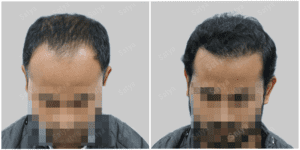 hair transplant before and after