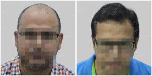 hair transplant before after results
