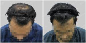 hair transplant before and after