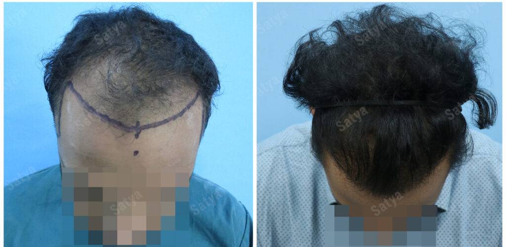 hair transplant before after results