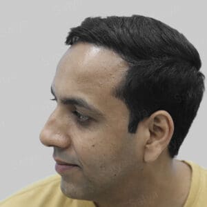 repair hair transplant