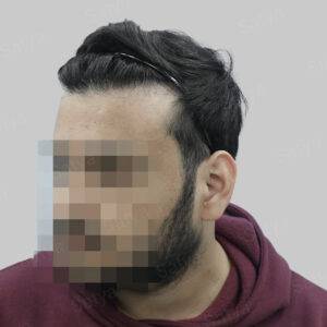 hair transplant
