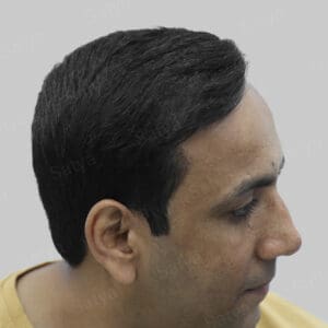 repair hair transplant