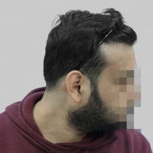 hair transplant