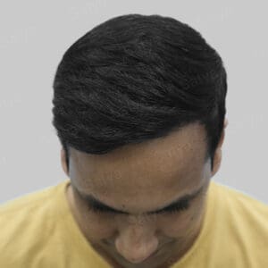 repair hair transplant