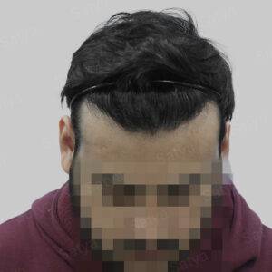 hair transplant