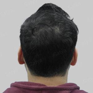 hair transplant