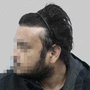 hair transplant