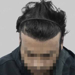 hair transplant