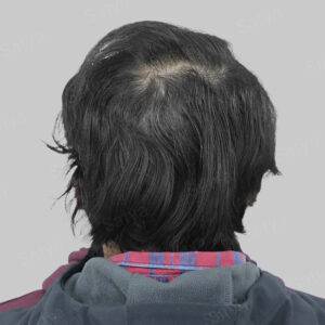 hair transplant