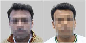 hair transplant before and after