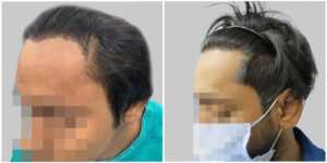 hair transplant