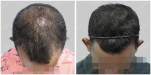 hair transplant before after results
