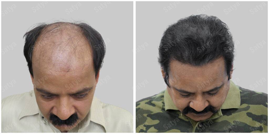 hair transplant before and after
