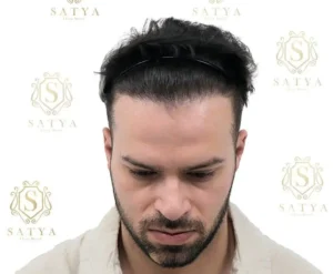 Hair Transplant Cost in India