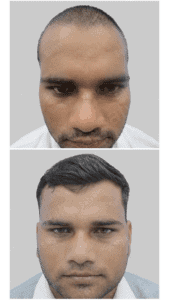 fue hair transplant