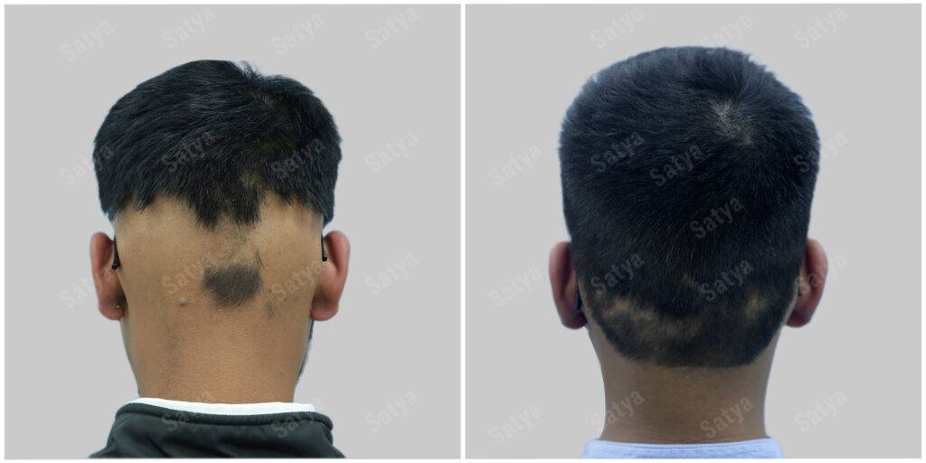 male hair transplant surgery