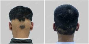 male hair transplant surgery