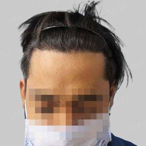Hair Transplant Cost in India