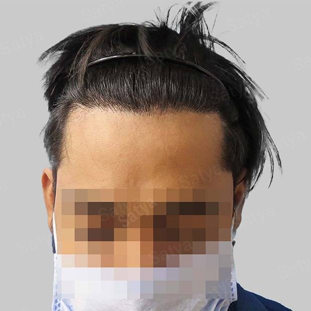 Hair Transplant Cost in India