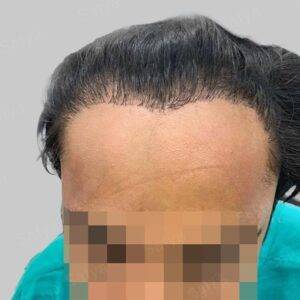 Hair Transplant Cost in India