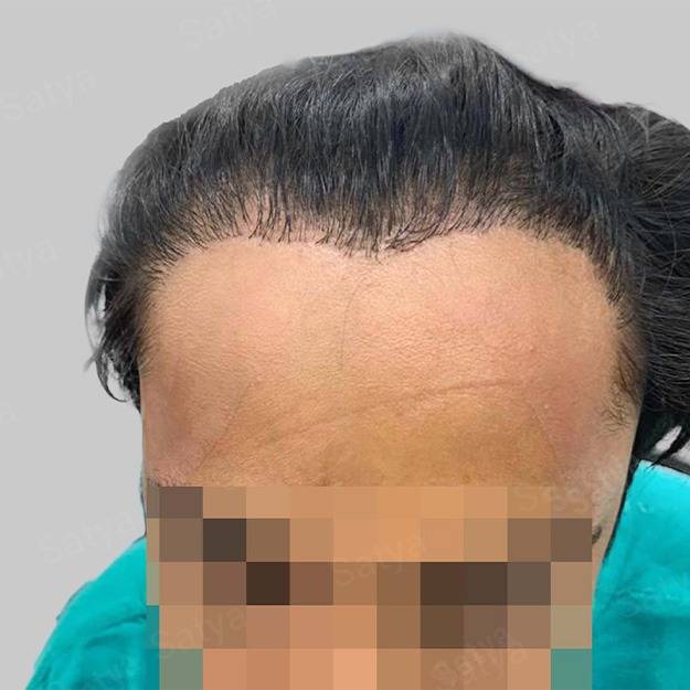 Hair Transplant Cost in India