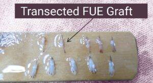 Difference Between FUT & FUE Hair Transplant