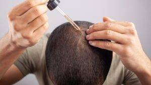 Side effects of Minoxidil