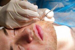 The Beard Transplant in Delhi