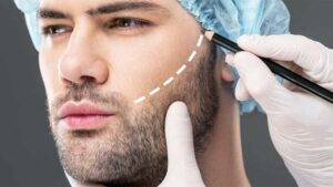 The Beard Transplant Process