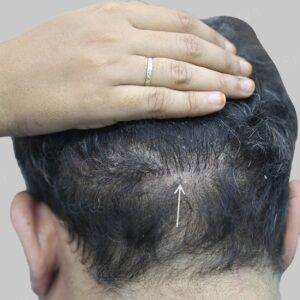 fue hair transplant