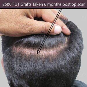 fut hair transplant