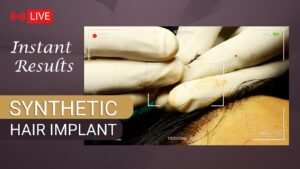 synthetic hair implant